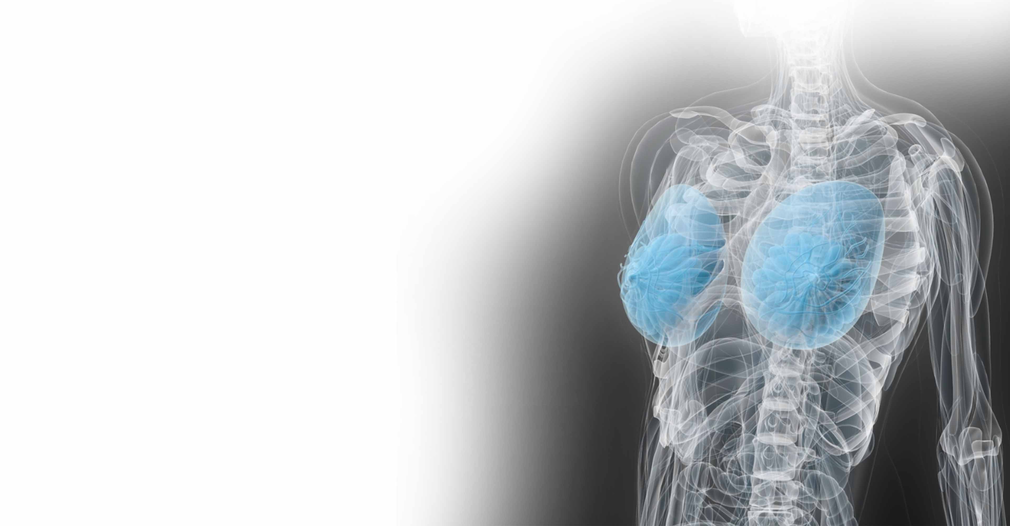 Radiotherapy for Breast | Elekta