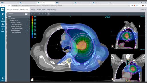 Screenshot of demo lung CT scan on ProKnow