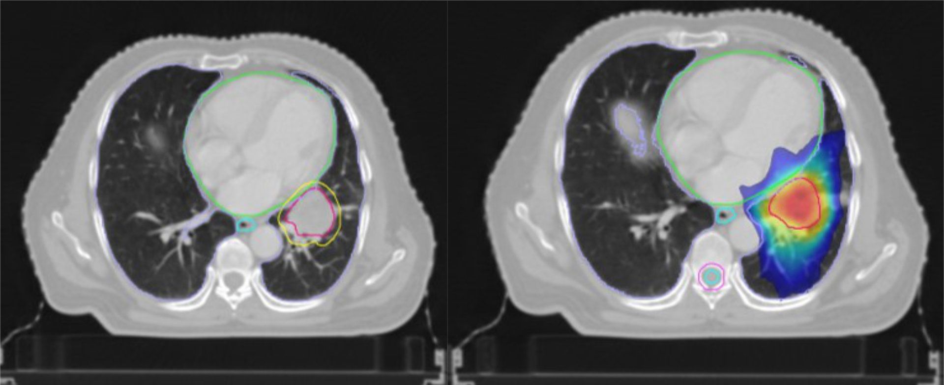 Lung Cancer Image