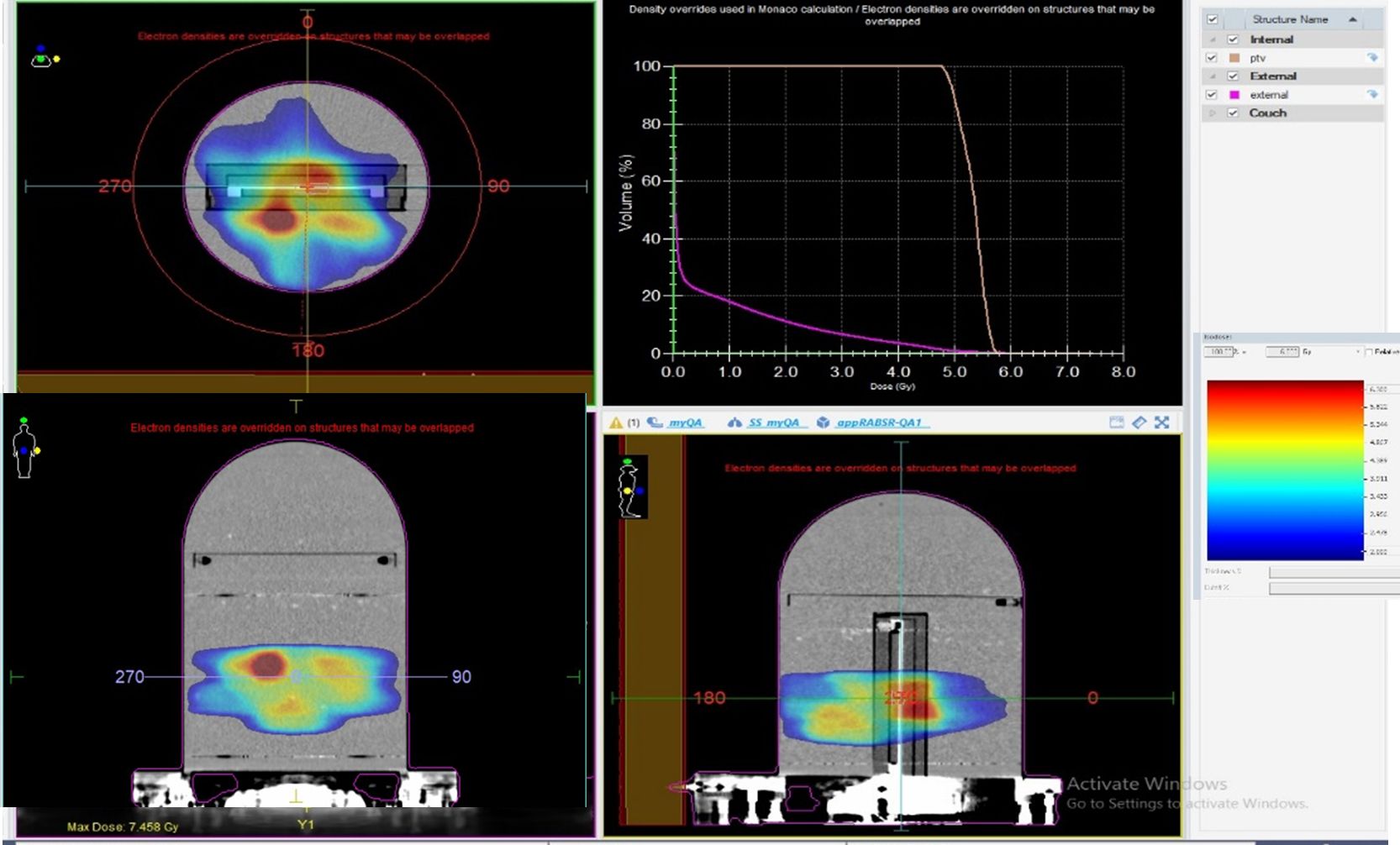 Sbrt Spine Treatment With a Boost Region Close to the Spinal Cord