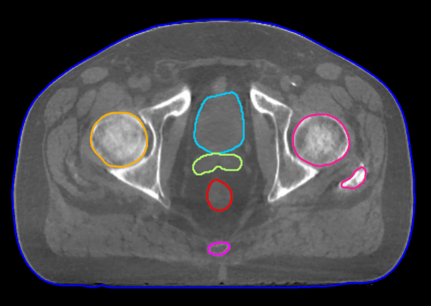 Example of a high definition, AI-enhanced CBCT image