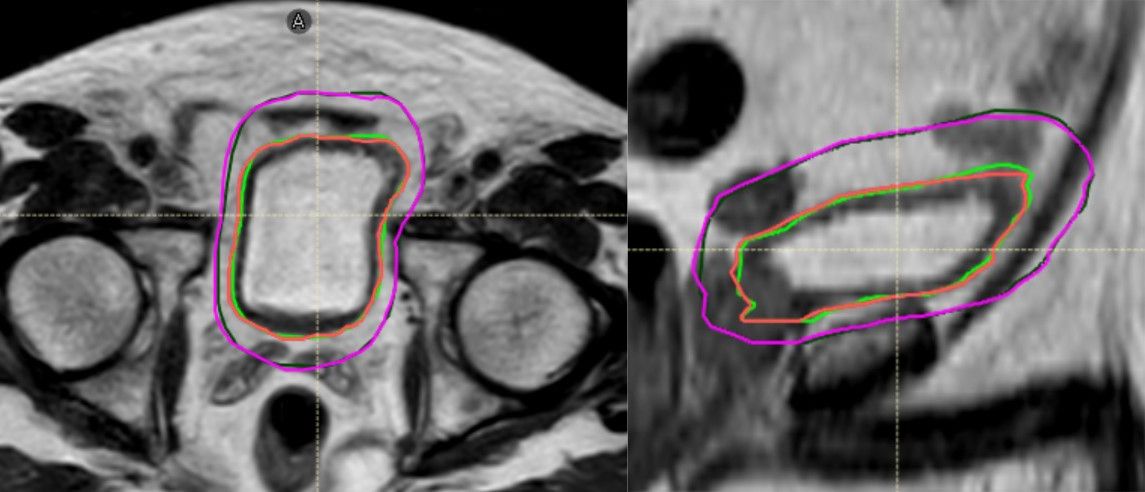 Transverse Bladder Target Volume Comparison View