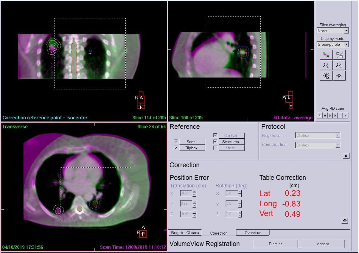 Figure 6 Left Side Mfov Scan