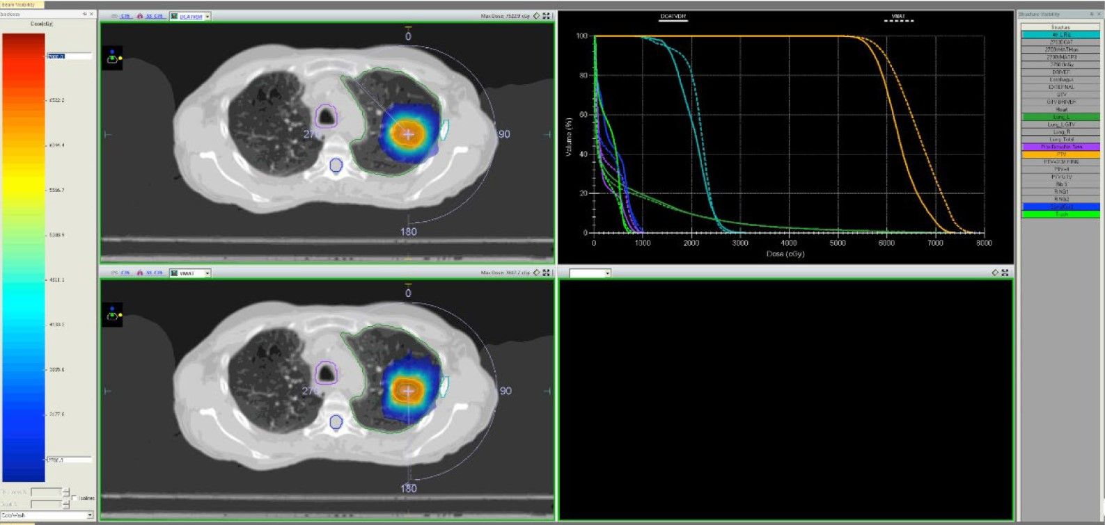 Comparison of isodose distributions seen for left and right breast with
