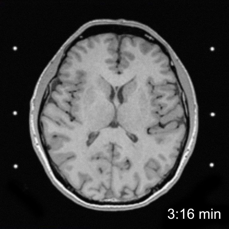 MRI Scan comparison