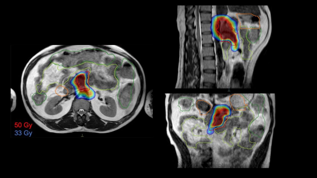 High dose (50 Gy) coverage of the GTV overlaid on MRI acquired on Elekta Unity MR-Linac