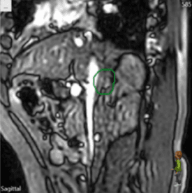 Metastasis2